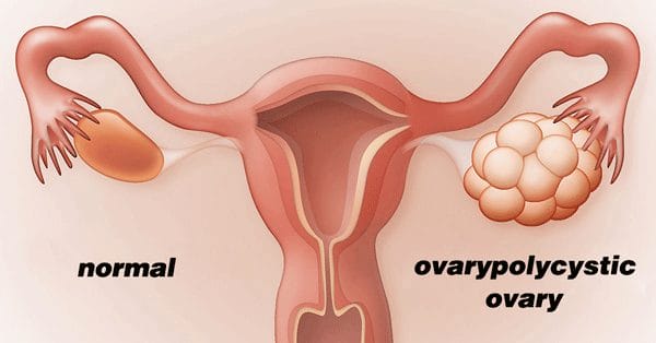 polycystic ovary